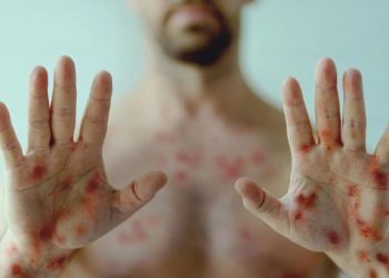 Sete Lagoas INVESTIGA DOIS casos de Mpox!