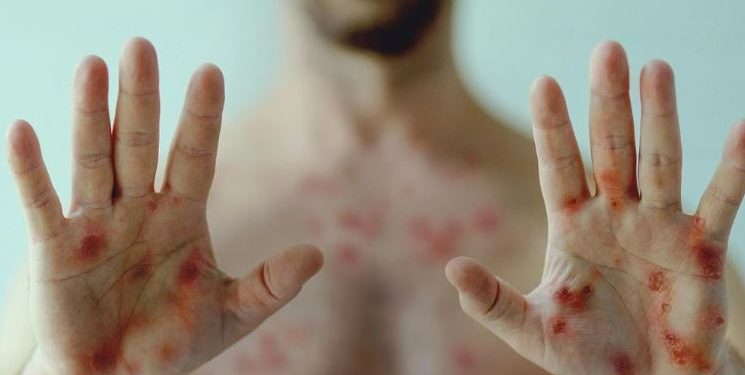 Sete Lagoas INVESTIGA DOIS casos de Mpox!